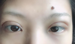 双眼皮埋线视频全过程,从术前准备到术后恢复